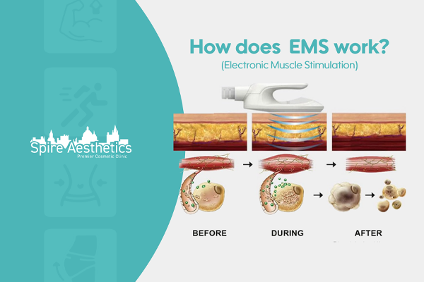 EMS treatment for post pregnancy weight loss treatment Aberdeen