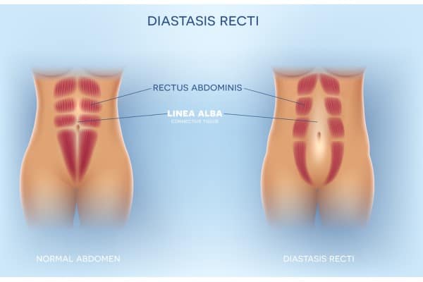 What Non-Surgical Options Are Available for Diastasis Recti Aberdeen?