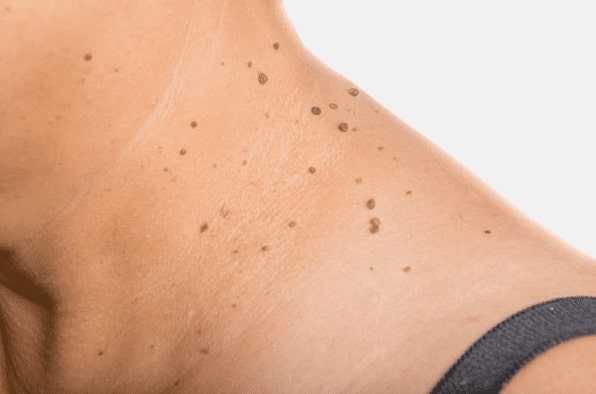 Are you looking for easy skin tag removal Aberdeen - then contact Spire today!