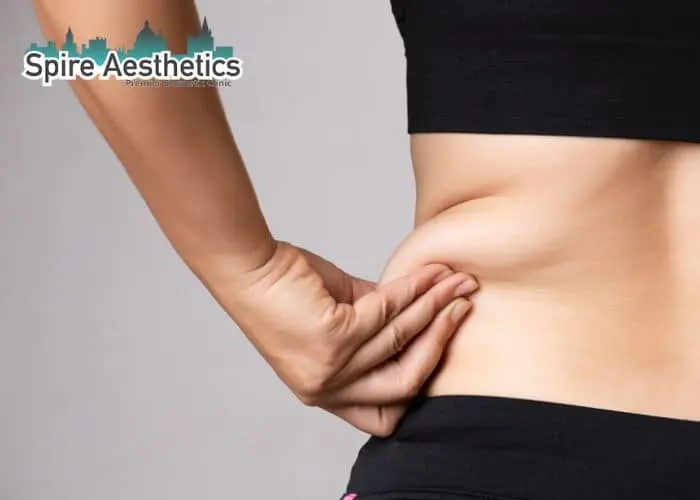 Image of woman pinching fat on their hips Aberdeen. Fat Freezing treatment