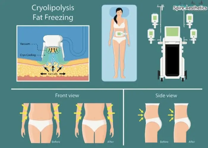 Fat freezing treatment Aberdeen benefits for competitions to remove stubborn fat deposits.