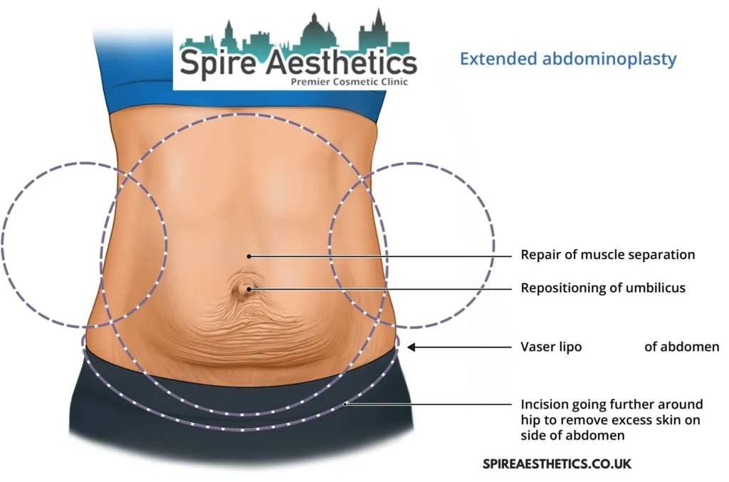 Understanding Loose Skin After Gastric Band Aberdeen Surgery and HIFU Treatment