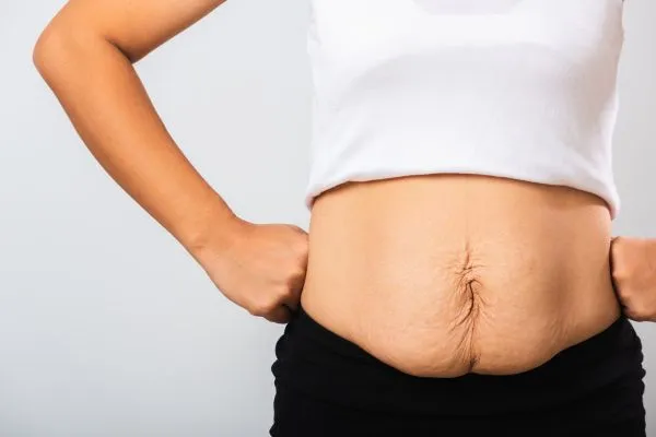 Image of a woman's stomach after weight loss with sagging skin following a gastric band Aberdeen