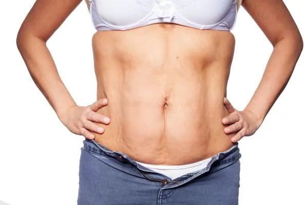 sagging skin on woman's stomach after weight loss injections Aberdeen