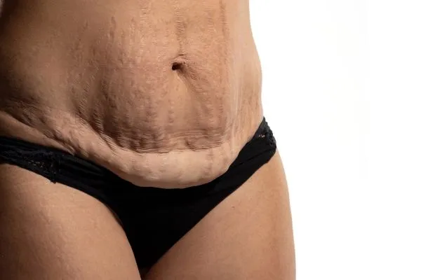 Image of womans stomach after weight loss injections Aberdeen showing saggy skin