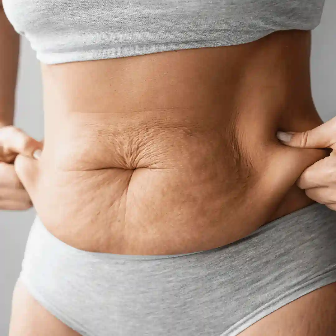 Is It Normal to Have Loose Skin After Pregnancy Aberdeen?